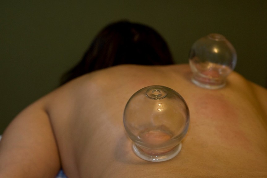 The History and Clinical Application of Cupping