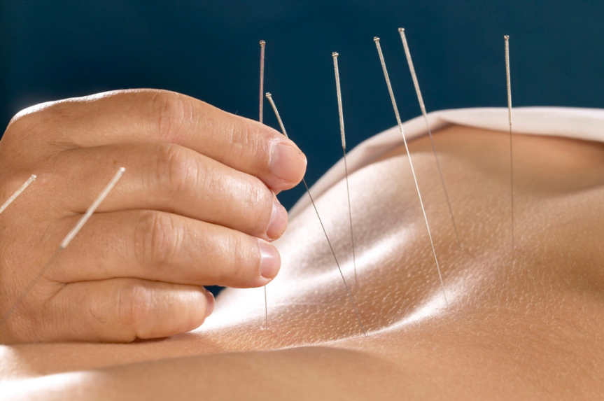 Most Common Reasons People Get Acupuncture